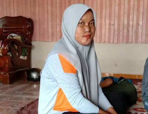 Sakit Tapi Tiada Pilihan, Mangsa Simbahan Cuka Getah Cuba Bertahan Pulihkan Wajah 4 Sakit Tapi Tiada Pilihan, Mangsa Simbahan Cuka Getah Cuba Bertahan Pulihkan Wajah